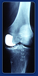Knie 1